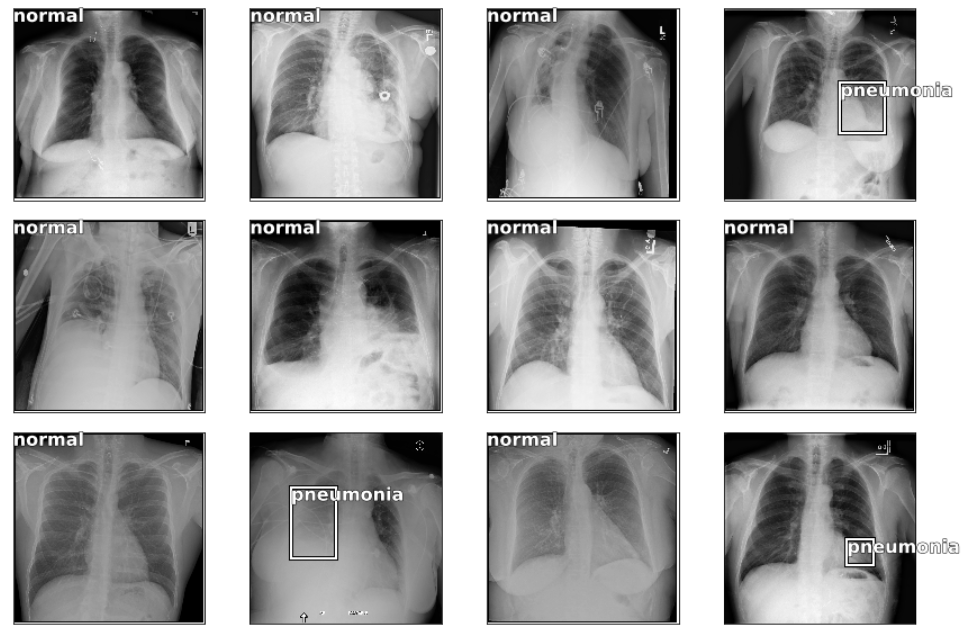 Detecting Pneumonia In Chest Radiographs With Fastai