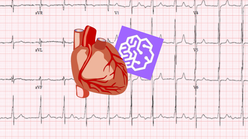 SageMaker Hyper-Parameter Optimization: classify heartbeat anomalies ...